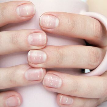 White spots on fingernails, Leukonychia